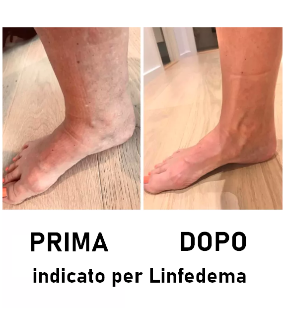 Gambali a compressione pneumatica sequenziale che operano su tutta la gamba, con una tecnologia avanzata a Zone alternate. Indicato per Linfedema